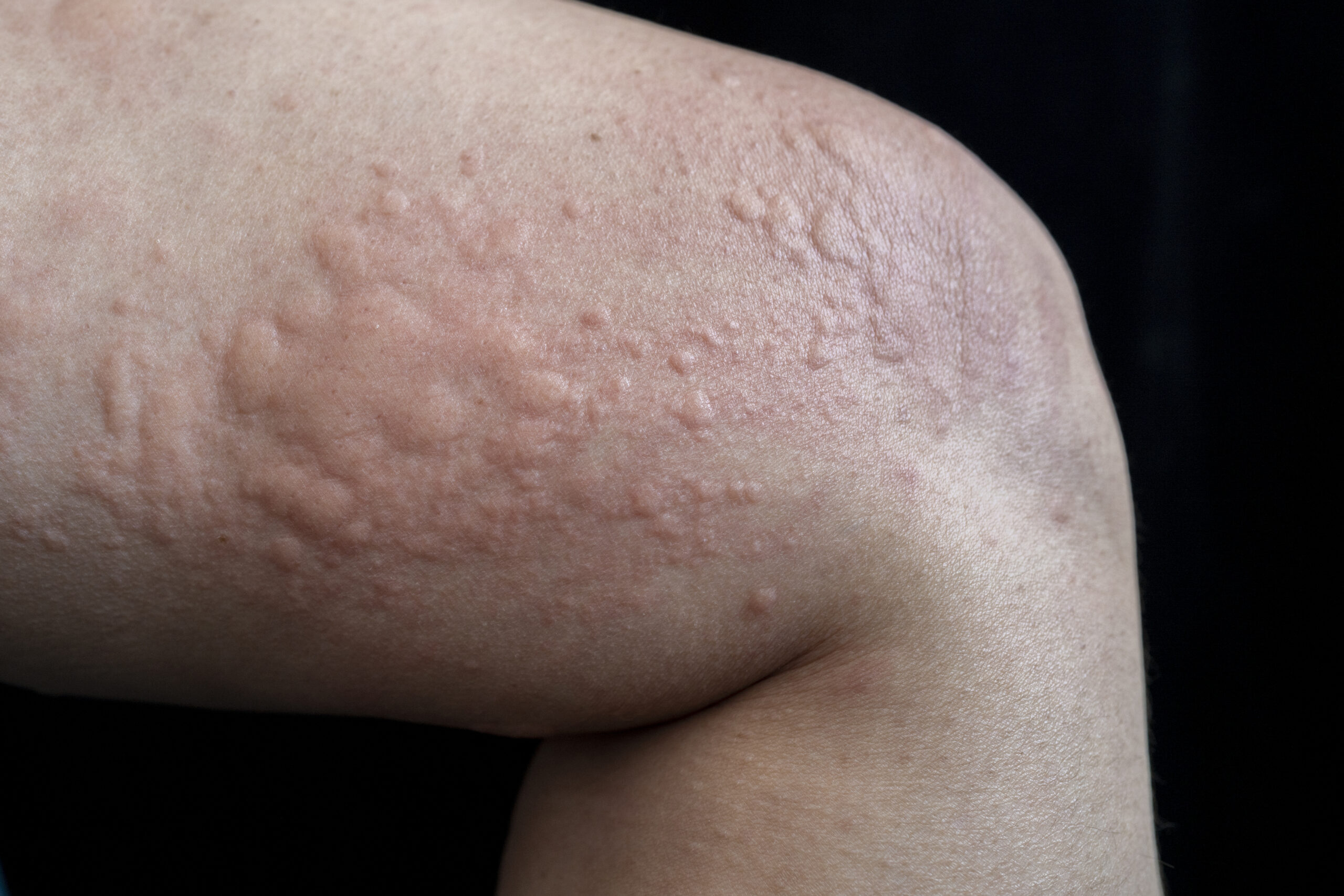 Skin Conditions That Mimic Chronic Hives