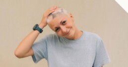 Woman with alopecia areata showing patchy hair loss