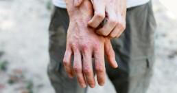 Skin condition eczema visible on fingers and hands