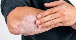 Patient with severe psoriasis on elbow participating in clinical trial