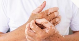 Vitiligo affecting skin pigmentation on patient’s hands